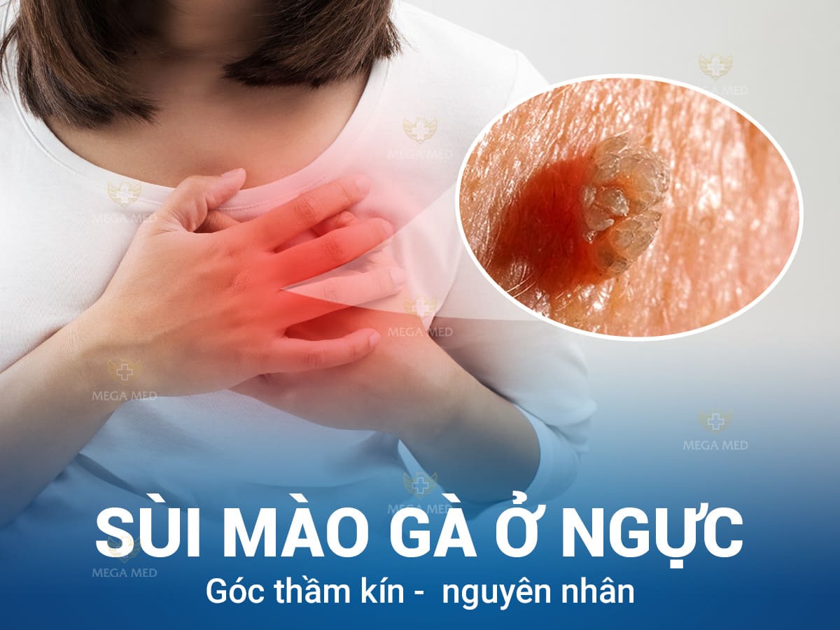 Sùi mào gà ở ngực